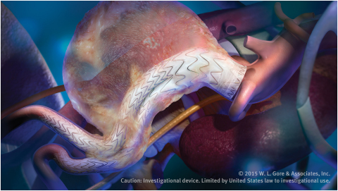 GORE® EXCLUDER®適形性AAA器材旨在治療具有挑戰性解剖畸形的腹主動脈瘤(AAA)病患。（照片：美國商業資訊）