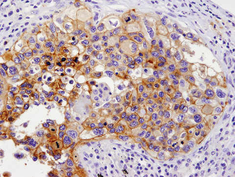 採用PD-L1 (E1L3N) XP® 兔子 mAb對石蠟包埋的人類肺癌進行免疫組織化學分析。（照片：美國商業資訊） 