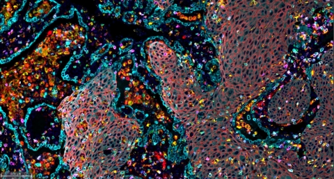 描繪非小細胞肺癌(NSCLC)樣本中免疫浸潤的多重免疫螢光圖像。（照片：美國商業資訊） 