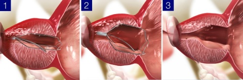 iTind, a temporarily implanted nitinol device, supports the relief of LUTS due to BPH in a minimally invasive way. (Graphic: Business Wire)