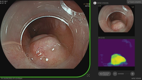 由Pradeep Bhandari教授提供：「一旦發現腫瘤，該系統將拍攝靜止影像並傳輸至螢幕右上角，作為內視鏡醫師的參考影像。它同時擁有熱區圖，可顯示AI預測的腫瘤部位。」（圖片：美國商業資訊） 