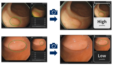 Cx20功能支援病變識別：在檢查過程中，透過內視鏡器材拍攝的視訊自動偵測疑似病灶。然後醫生抽取靜止影像（左），快速分析並顯示結果（右）（圖片：美國商業資訊）