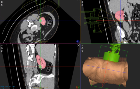 Example of HistoSonics technology targeting kidney tissue to be destroyed in a non-invasive histotripsy procedure. (Photo: Business Wire)