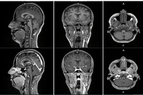 First-in-human contrast enhanced MRI images with GE HealthCare's mangaciclanol