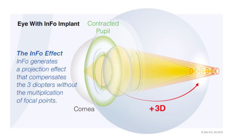 瑞士SAV-IOL开发的新款人工晶状体InFo上市（图示：美国商业资讯） 